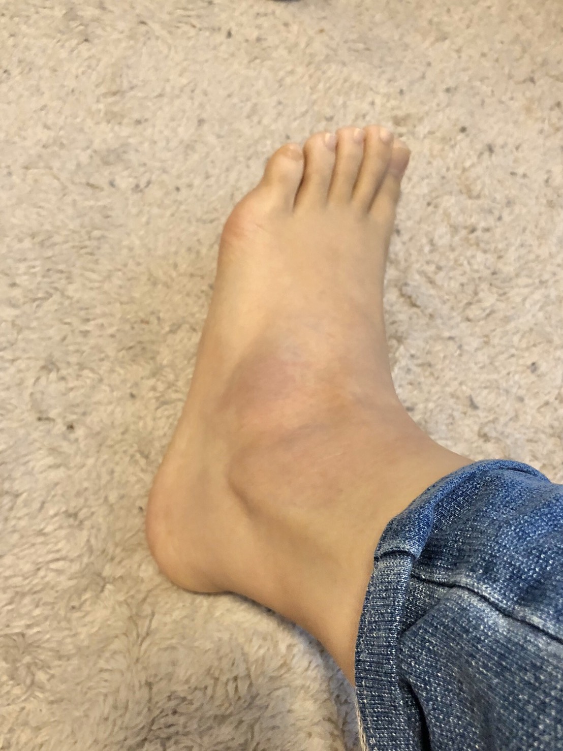 足の捻挫 骨折 こうぞう整体院 接骨院こうぞう整体院 接骨院